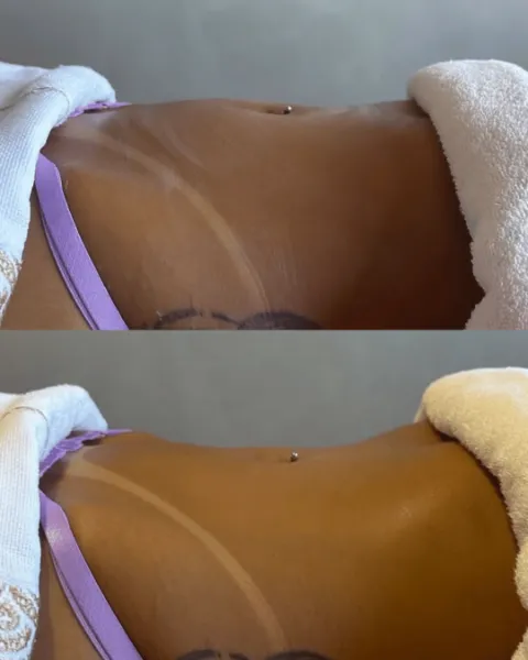 Drenagem linfática: resultado de paciente da Elyssium Clinic