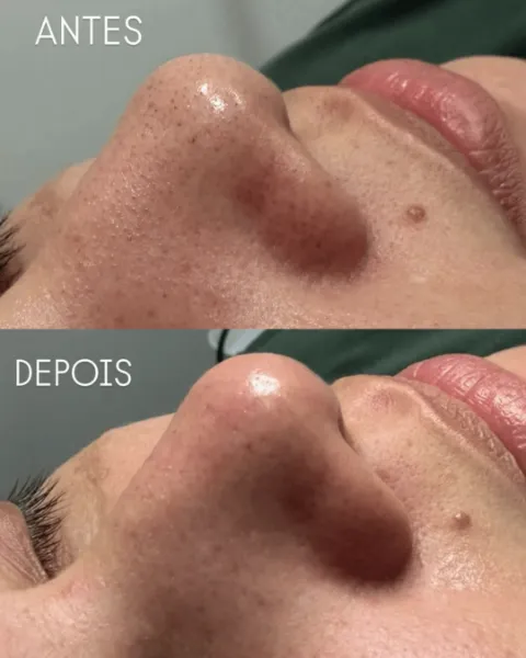 Limpeza de pele: resultado de paciente da Elyssium Clinic